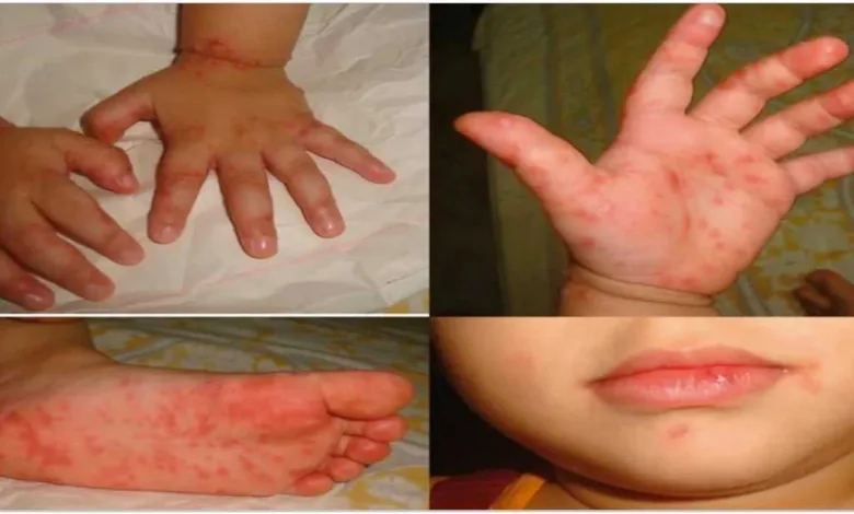 Children s hand foot mouth disease is increasing in schools